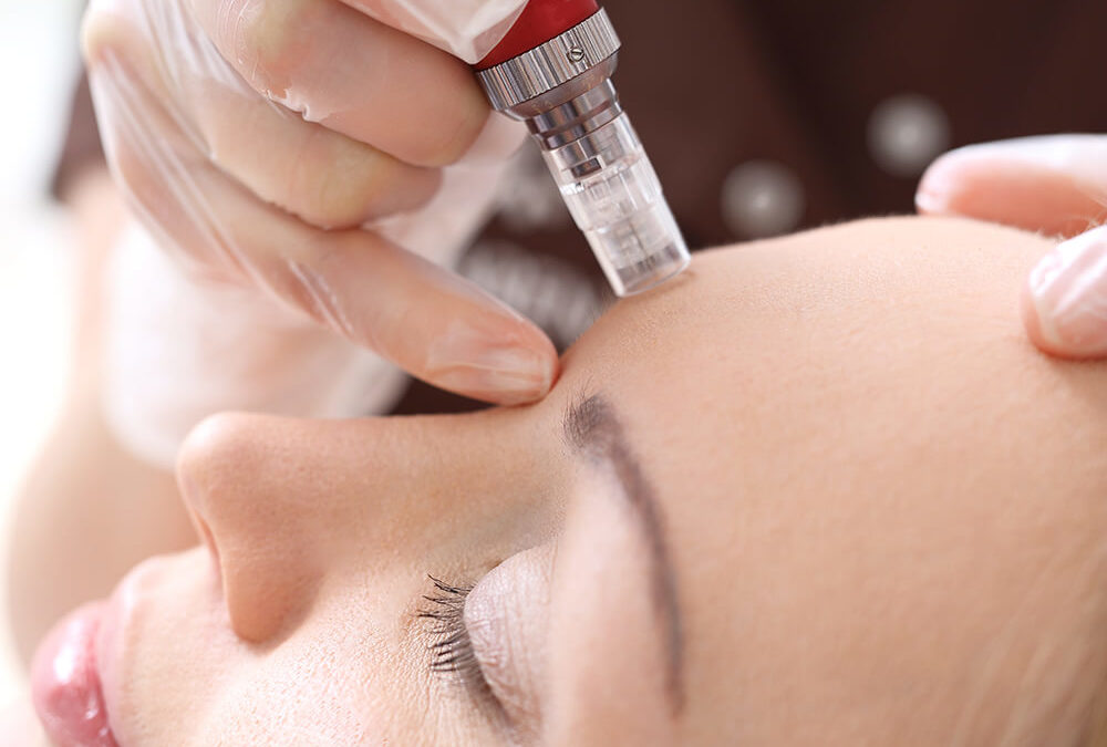 Microneedling: The Natural Anti-Aging Secret