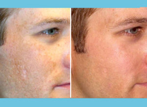 Microneedling Before After 2