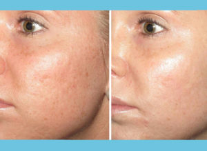 Microneedling Before After 1
