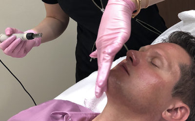 What is the difference between traditional Microneedling and Radio Frequency (RF) Microneedling?