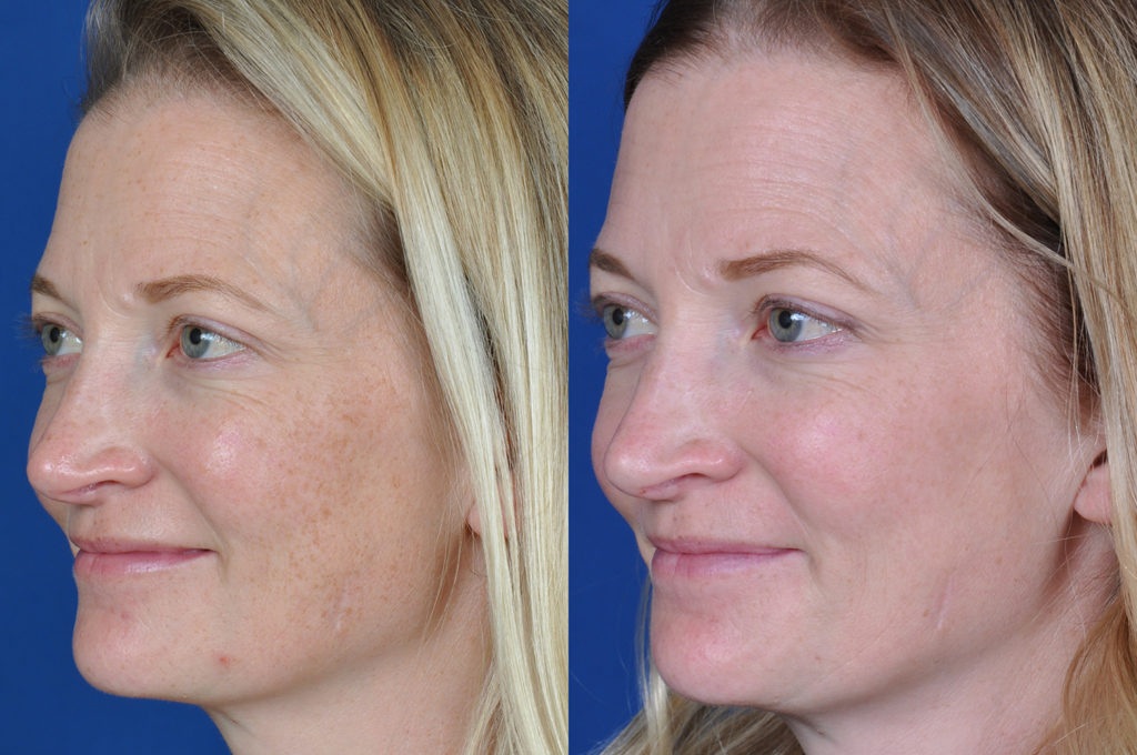 Before and after light treatment for skin